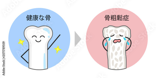 Foto 健康な骨と骨粗鬆症の骨の比較イラスト