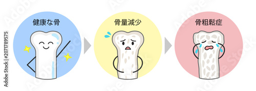 Fotografía 健康な骨と骨量減少と骨粗鬆症の骨の比較イラスト