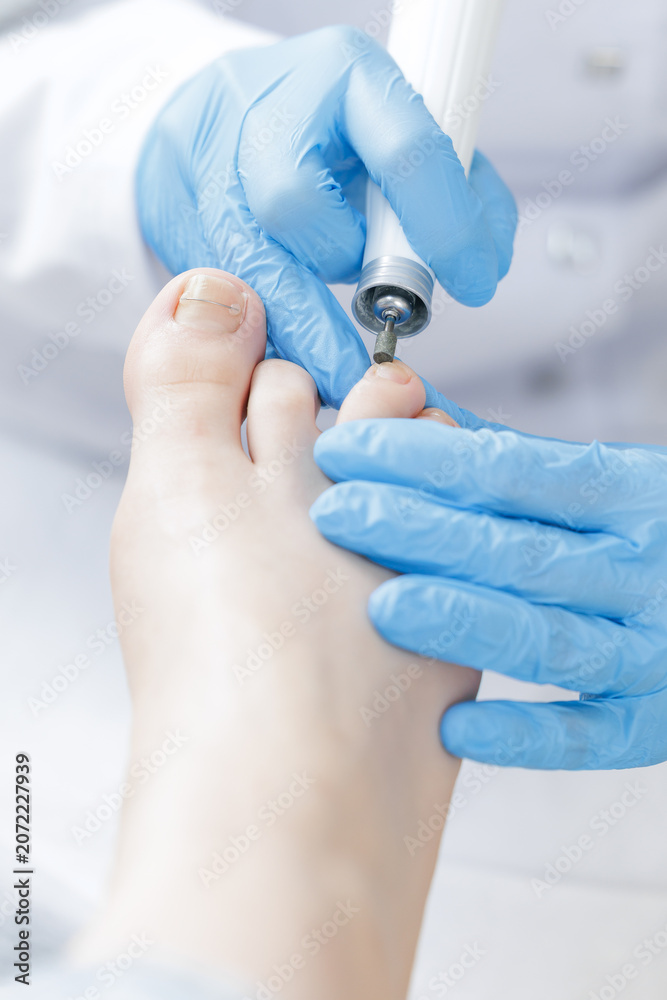 Fototapeta premium Podiatrist treating caucasian adult foot with precision tools