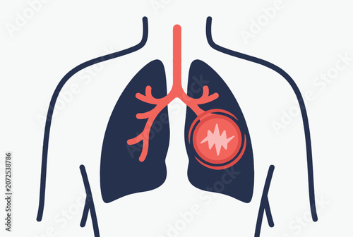 Simple medical diagram of a human chest cavity showing lungs with a highlighted red area of pain or infection.
