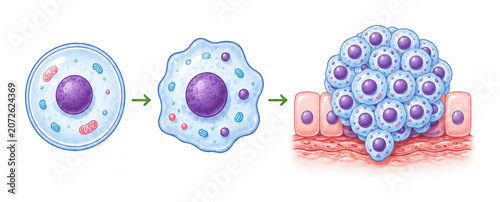 Medical Illustration Showing Stages of Abnormal Cell Growth and Tumor Formation