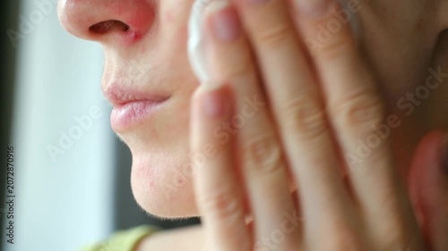 Close up female face with red pimples, allergic rash, carefully applying medical treatment with cotton pad to sensitive skin, focusing on dermatological care. Woman treating facial skin allergy rash