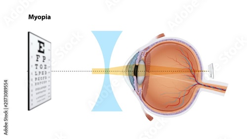 Myopia Correction Animation Nearsightedness Vision Disorder, Concave Lens Refraction, Human Eye Anatomy, Ophthalmology, Optometry, Medical Education, 2D and 3D Animation