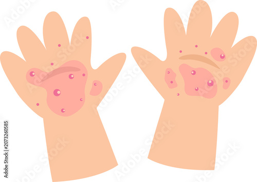 Hand, Foot and Mouth Disease in Children Illustration