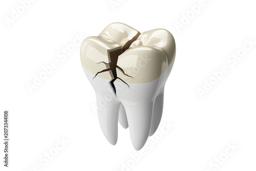 Cracked molar tooth with root fracture