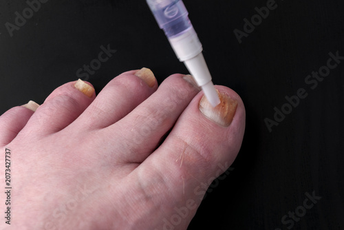 Foot with nail being treated with a medical tool to treat a fungal infection. Dark background emphasizes the action. Close-up shows care and precision in treatment. Ideal for health, beauty, or medica