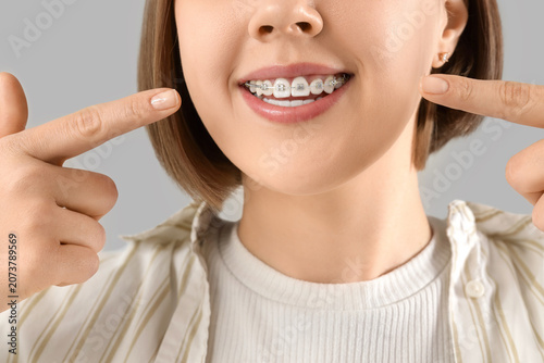 Tableau sur toile Young woman pointing at her teeth with dental braces on light background, closeu