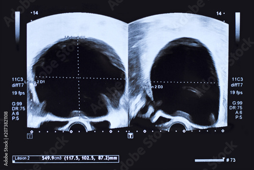 Ultrasound image of large round serous adenocystoma cyst in lower abdomen of woman printed on a piece of paper