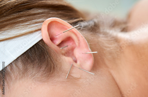 фотографія Beautiful woman relaxing on a bed having acupuncture treatment with needles in and around her ear