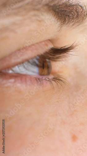 Keratoconus eye disease, cornea thinning and cone shaped eye distortion