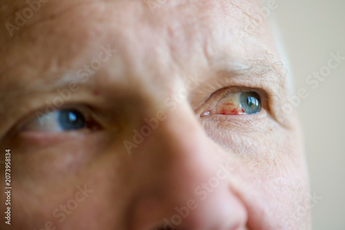 Close-Up of a red elderly man's eye with a burst capillary