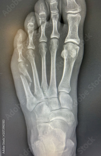 Slika na platnu Human foot x-ray showing bone trauma with a fracture to the first metatarsal bon