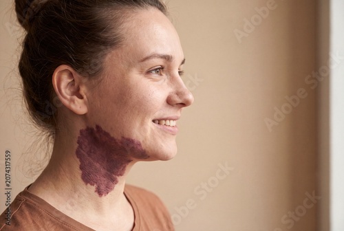 Profile portrait of a happy, confident woman with a prominent natural port-wine stain birthmark on her neck and jaw.
