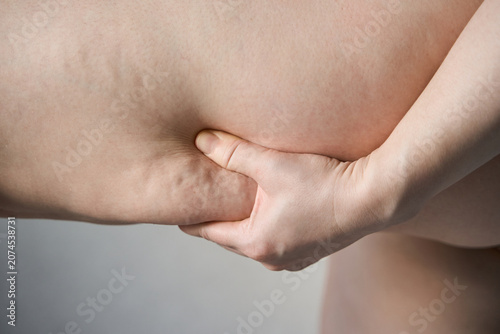 Schilderij op canvas Hand Pinching Abdomen Skin Showing Body Fat Close Up In Neutral Indoor Setting With Soft Light And Smooth Background