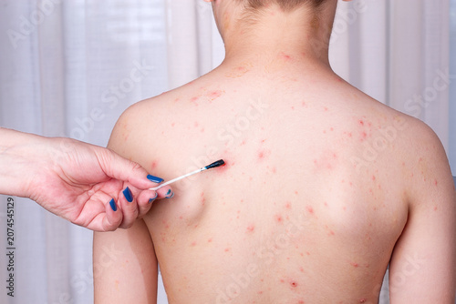 Canvastavla the child is standing with his back, he has a rash on his skin