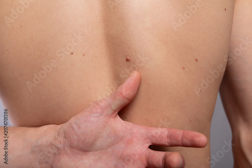 Bild auf Leinwand A mole and spots on the young man's back