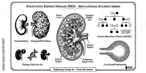 Foto PKD Kidney Disease Etching Black White-Cyst Distribution Enlarged Genetic-Polycy
