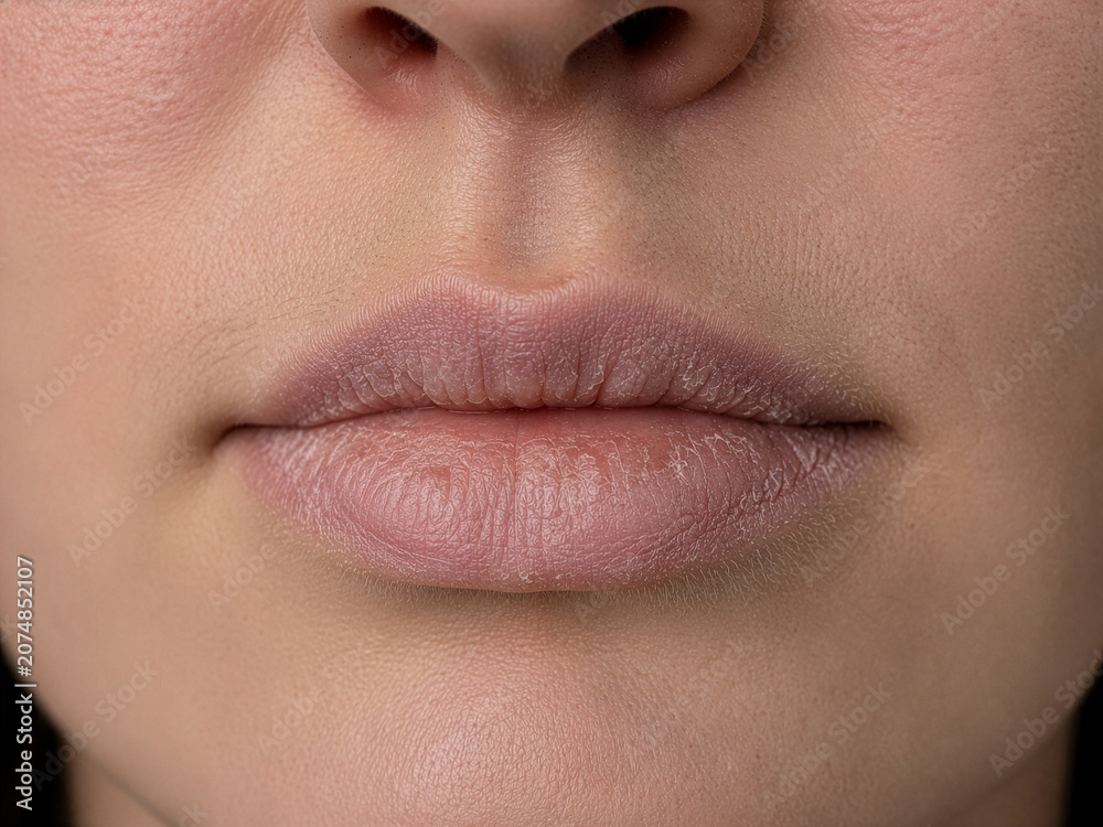 Obraz premium Dry Chapped Lips Close-up