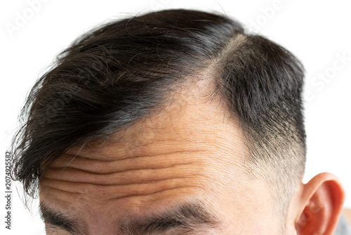 Konstfotografi Close-up of a man showing hair loss and receding hairline on his head, isolated on white background
