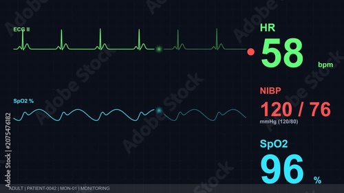 Medical monitor displays vital signs in a hospital setting with a heart rate