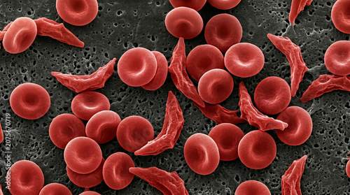 Normal red blood cells and sickle cell anemia under an electron microscope.