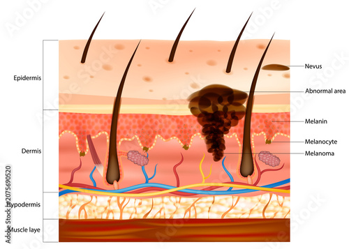Human Skin Layers with Melanoma Development Educational Medical Diagram of Epidermis Dermis and Hypodermis. Skin Cancer Melanoma Anatomy Illustration. Malignant Melanocyte Progression
