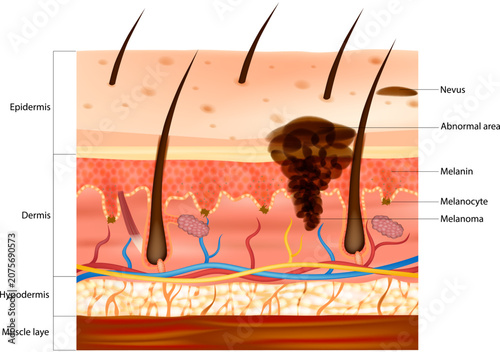 Human Skin Layers with Melanoma Development Educational Medical Diagram of Epidermis Dermis and Hypodermis. Skin Cancer Melanoma Anatomy Illustration. Malignant Melanocyte Progression