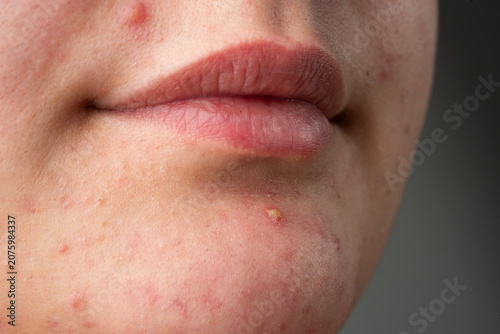 Foto Skin rash texture with acne