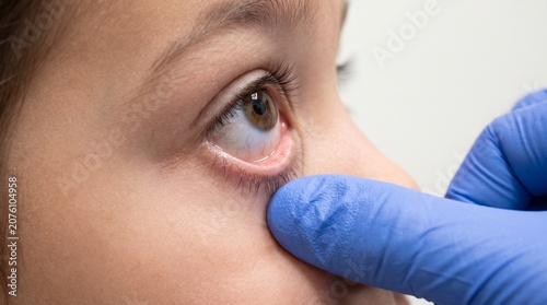 Pediatric Conjunctival Pallor Examination for Anemia Assessment