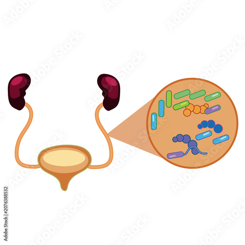 Human urinary system diagram illustrating microbial bladder infection vector art