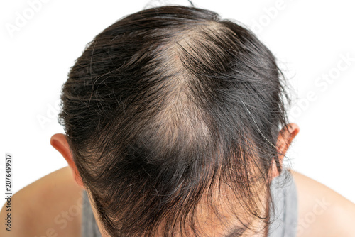 View of a person with thinning hair and visible scalp due to hair loss or alopecia, isolated on white background.