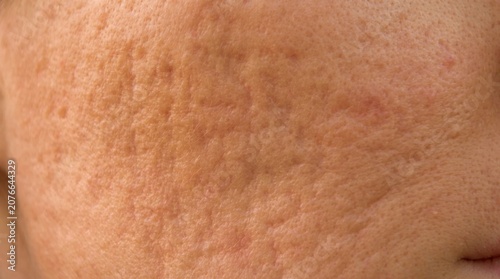 Smooth lighting on textured rolling acne scars on woman cheek