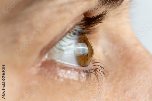 Advanced keratoconus eye disease macro profile view