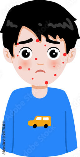Cartoon Illustration of a Boy with Chickenpox