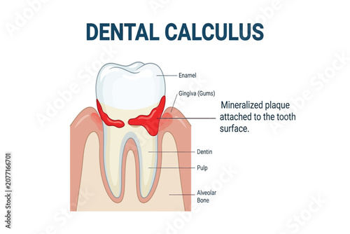 Cross-section of teeth showing mineralized plaque and gum inflammation.