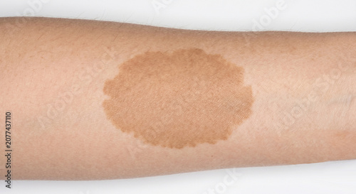 Fotografie Pigmented birthmarks - Café-au-lait birthmarks - close-up of a single large ligh