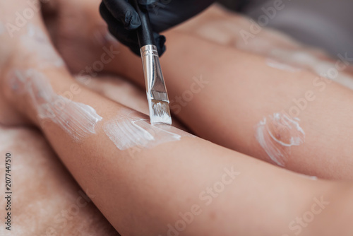 Bilde på lerret Aesthetic practitioner applies topical anesthetic cream to leg blemishes and scars before fractional laser resurfacing, helping improve patient comfort during treatment