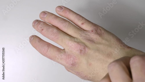 Close-up of a person scratching an itchy arm affected by skin irritation or allergic reaction. Dermatology, eczema, allergy symptoms, skin sensitivity, healthcare, and medical condition concept.