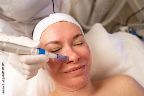 Woman undergoing microneedling facial therapy for dermapen skin care