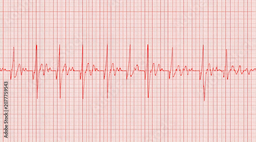 Electrocardiogram (ECG) Line: A close-up view of an electrocardiogram (ECG) or EKG waveform displayed on a grid paper, representing a heartbeat.