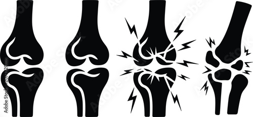 Foto Knee joint pain vector icon set, arthritis bone destruction progress stages silh