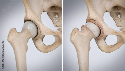 Hip joint comparison medical illustration showing normal anatomy versus femoroacetabular impingement with mixed cam, pincer morphology for orthopedic education, radiology, patient healthcare design