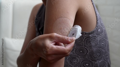 Close up of a woman hands removing a round adhesive plaster from a continuous glucose monitoring CGM sensor on her upper arm, managing diabetes healthcare at home