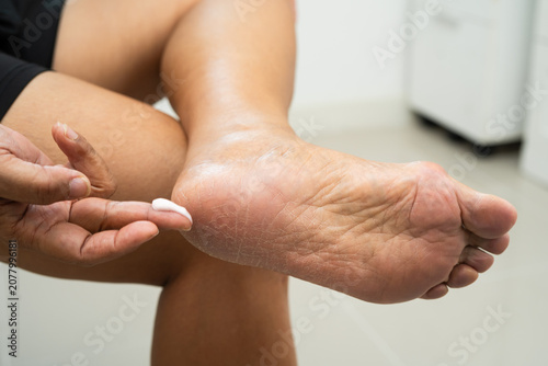 Asian woman check feet with crack and dry heel skin, Diabetic Foot.