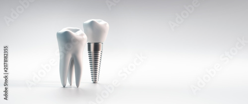 Obraz na płótnie Dental implant and molar tooth isolated on white background with copy space - 3D