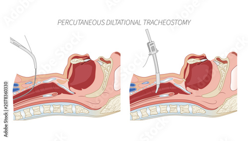 Φωτογραφία PERCUTANEOUS DILTATIONAL TRACHEOSTOMY, highlighting key anatomical landmarks and stepwise airway access