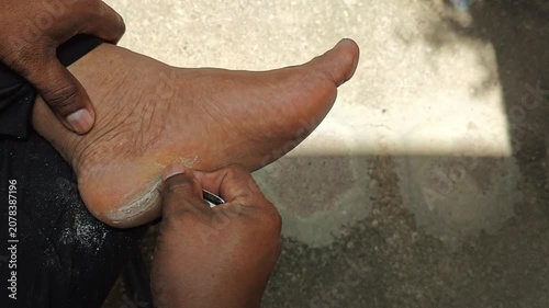 Process of manually scraping dry and hard callused skin on the sole of the foot