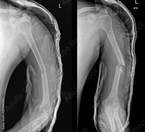 Tableau sur toile Radiology of Humeral Fractures: Diagnostic Features and Clinical Correlation