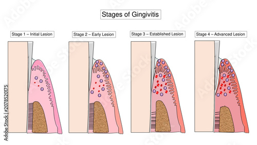 Bild auf Leinwand Stages of Gingivitis Progression and Periodontal Tissue Breakdown Vector Illustr