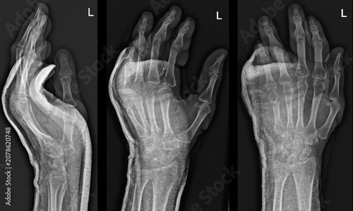 Foto Imaging Analysis of Hand Trauma: Recognizing Common Fracture Patterns